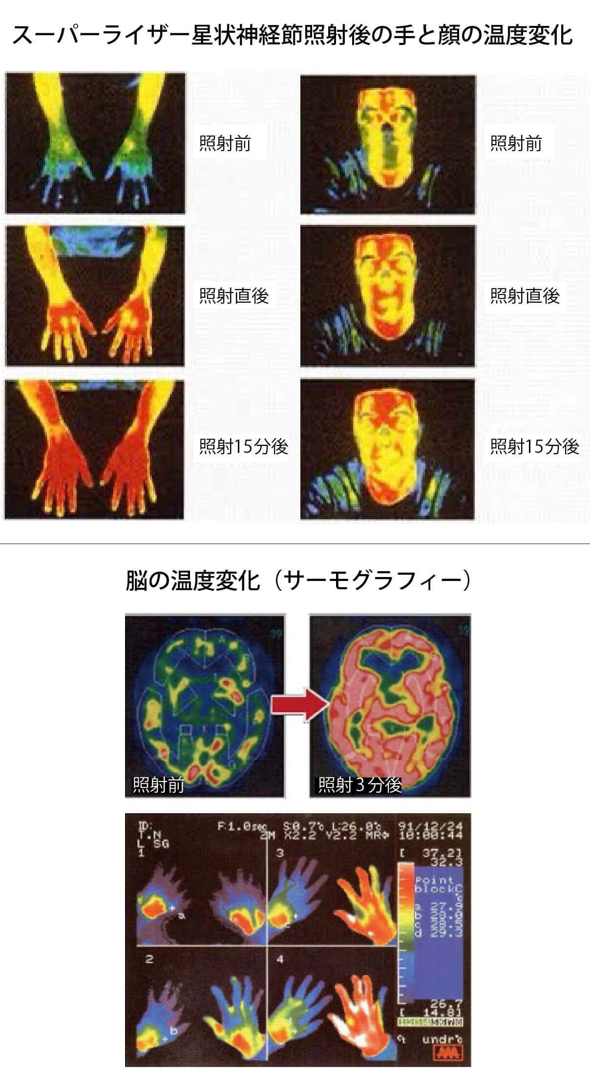 スーパーライザー星状神経節照射後の手と顔の温度変化